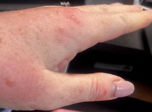 Woman feasted on by hotel bed bugs