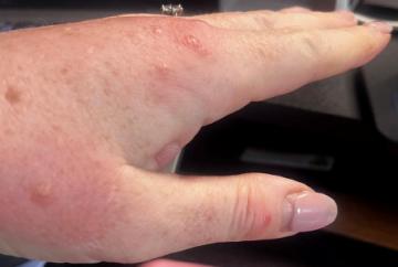 Woman feasted on by hotel bed bugs