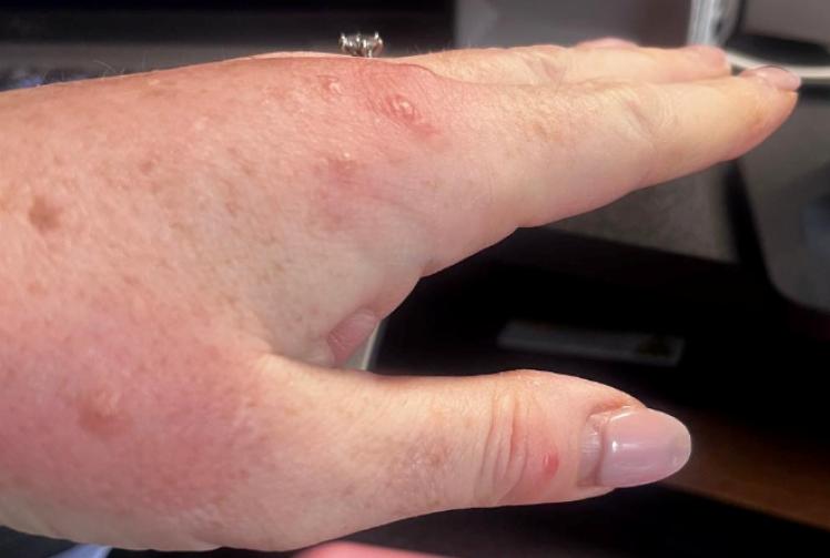 Woman feasted on by hotel bed bugs